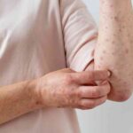 skin-allergy-on-person-s-arm